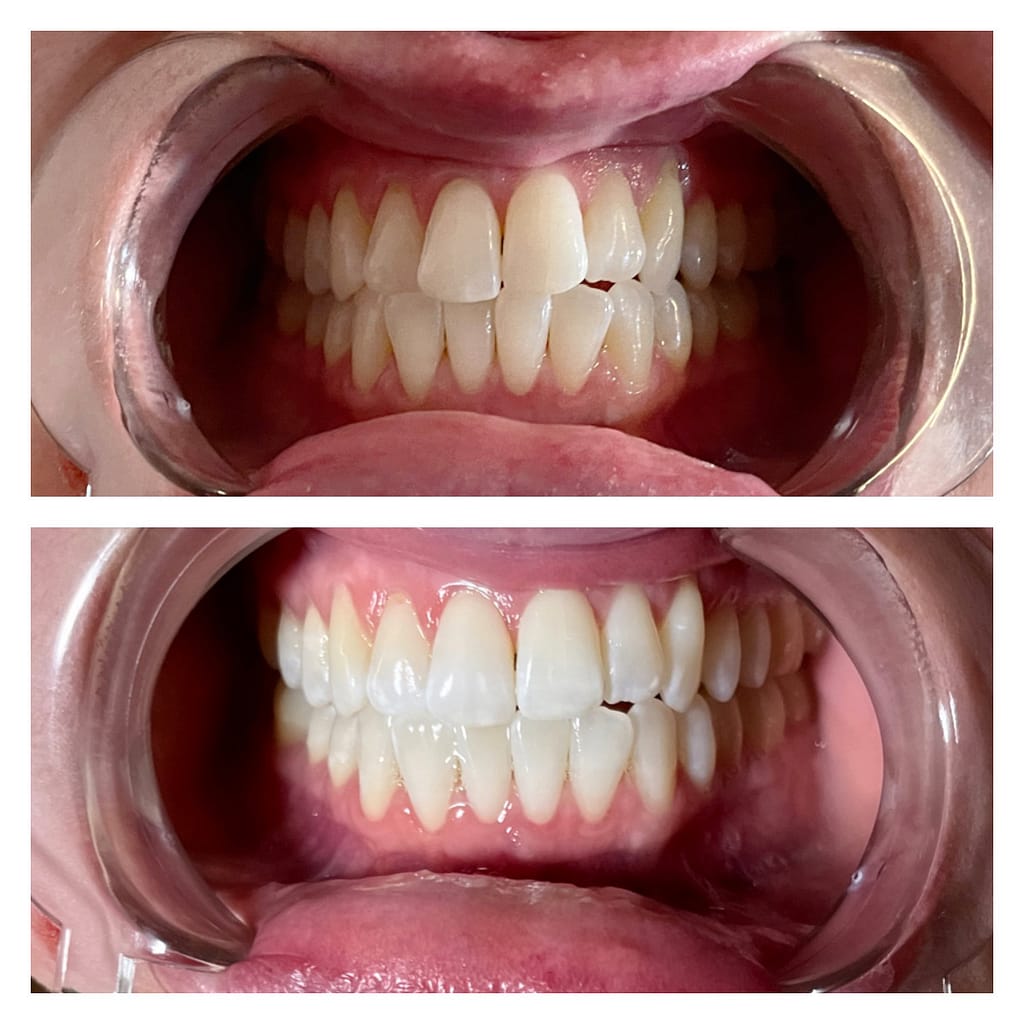 Teeth Whitening London Ontario